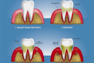 Gum Disease Treatment - Arcade Dental