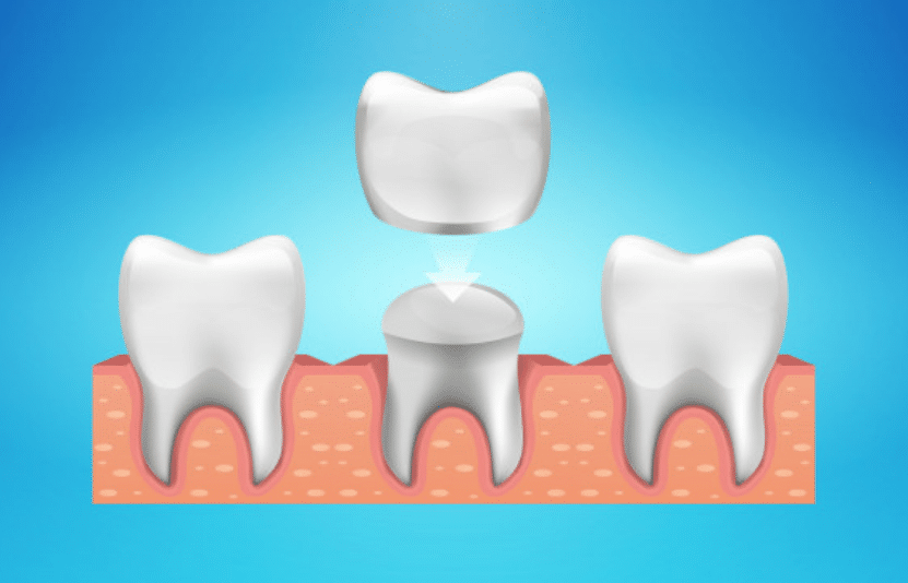 dental crown