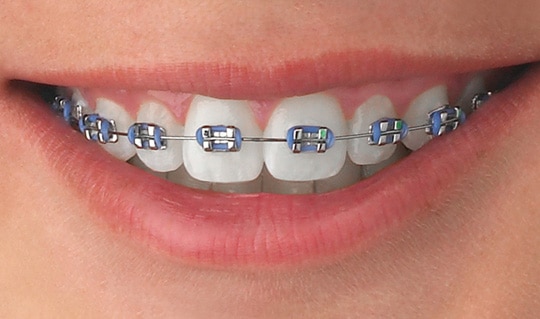 Dental Braces