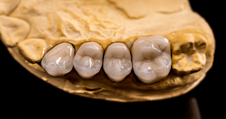Dental implants can last a lifetime with proper care