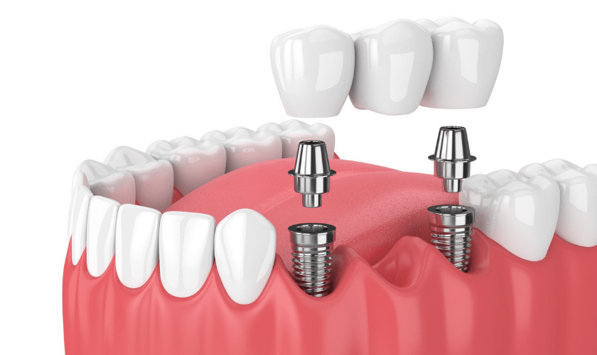 Dental implants can last a lifetime with proper care