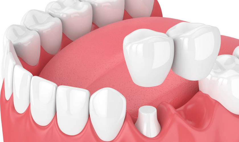 Dental implants can last a lifetime with proper care