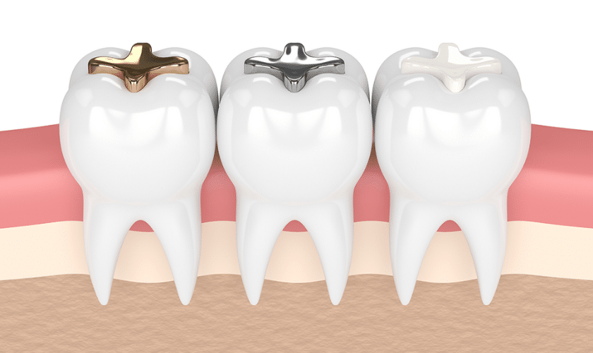 Types of Tooth Fillings