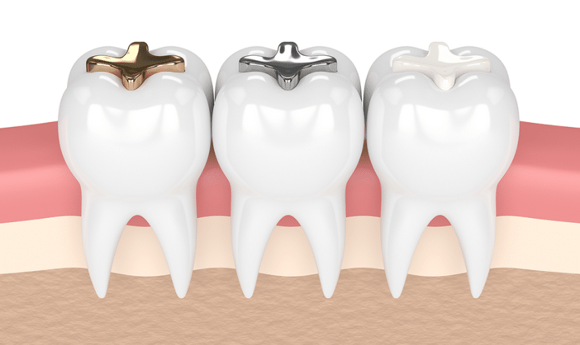 Dental implants can last a lifetime with proper care