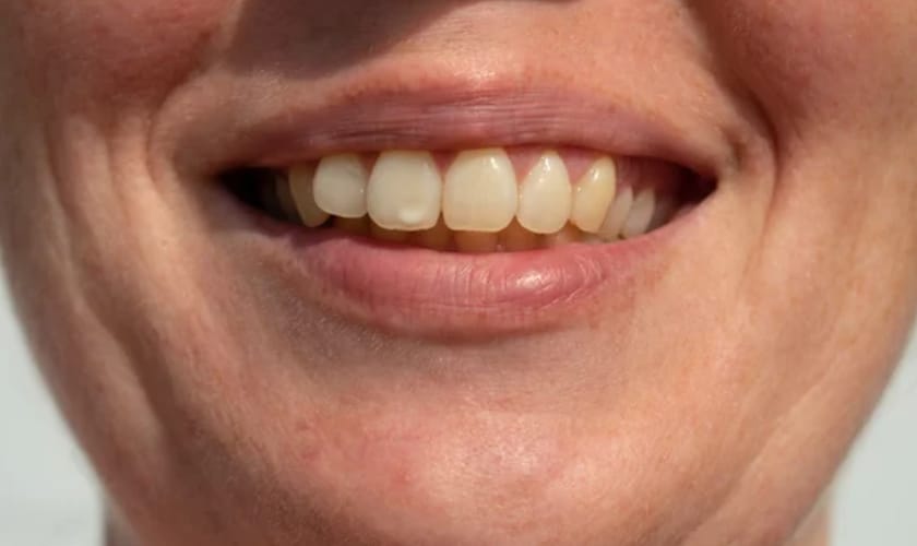 Dental implants can last a lifetime with proper care