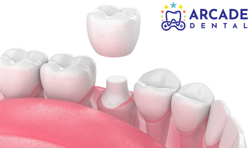 Dental Crowns