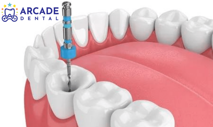 Dental implants can last a lifetime with proper care