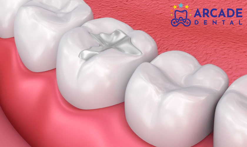 Advantages of Dental Fillings Pharr