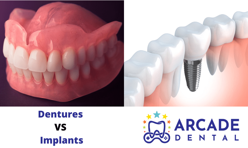 Dentures VS Dental Implants