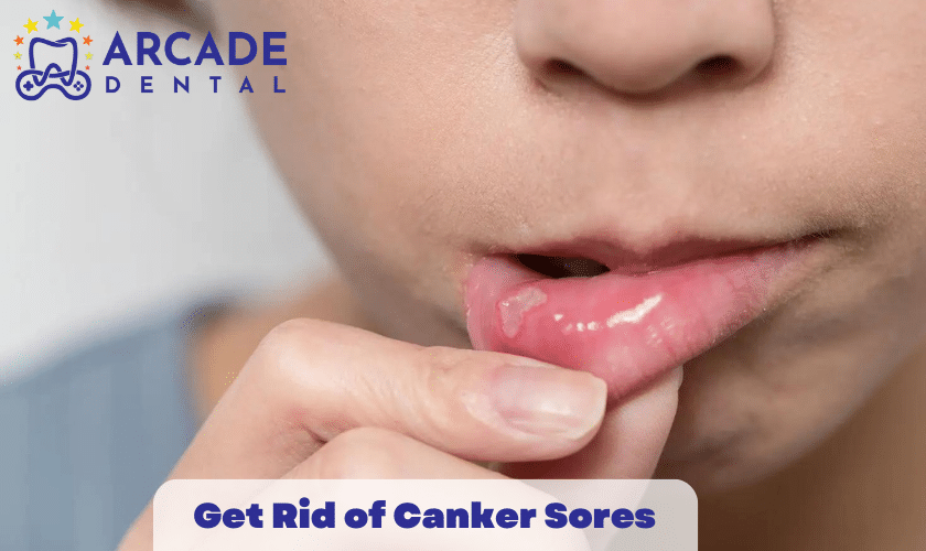 Get Rid of Canker Sores