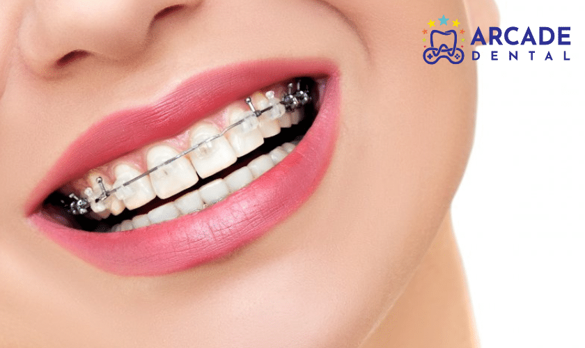 How to Take Care of Your New Braces