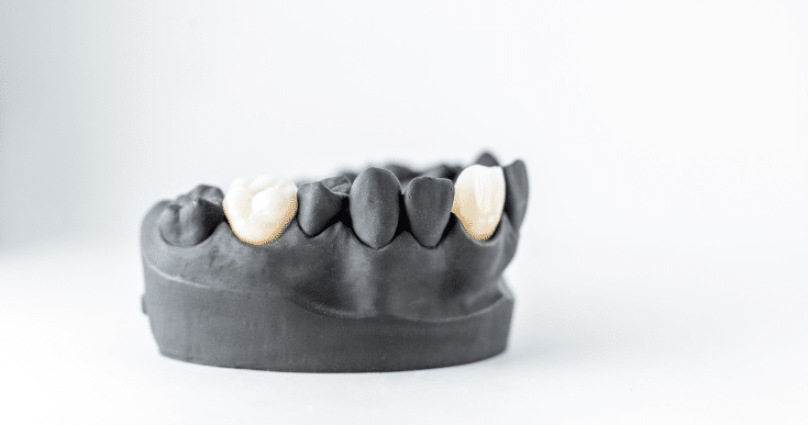 Dental Crown Broke Here Are Steps to Take Immediately