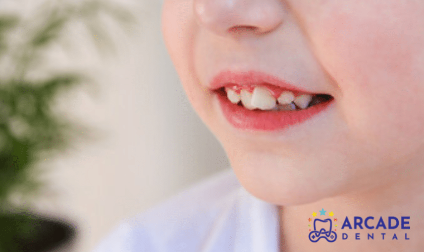 impact-of-crooked-teeth-on-childs-health