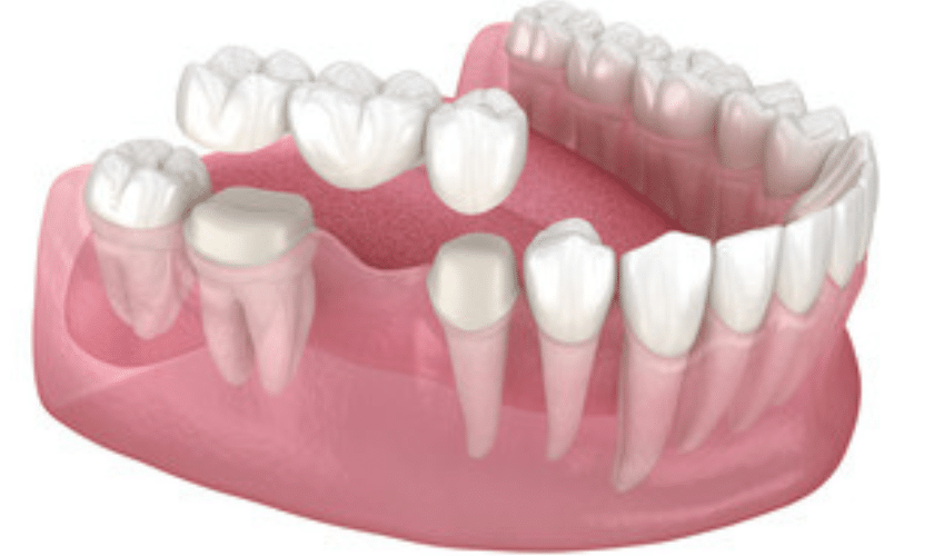Essential Aftercare Tips For Dental Bridges