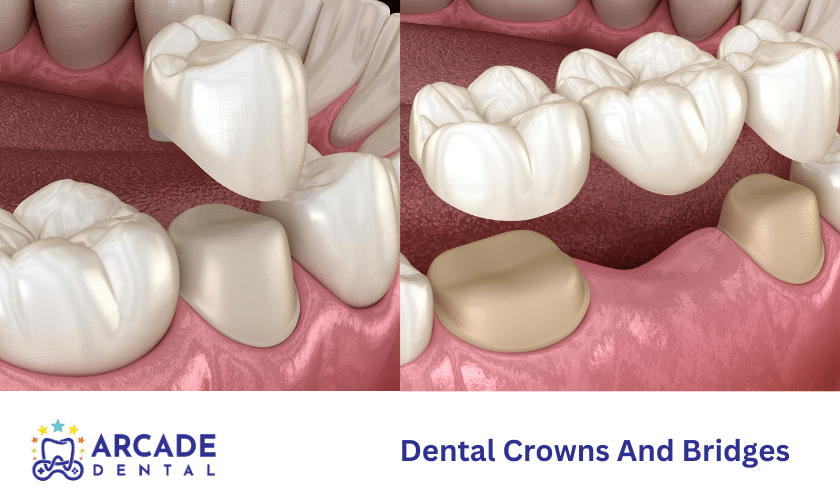 The Differences Between Crowns And Bridges