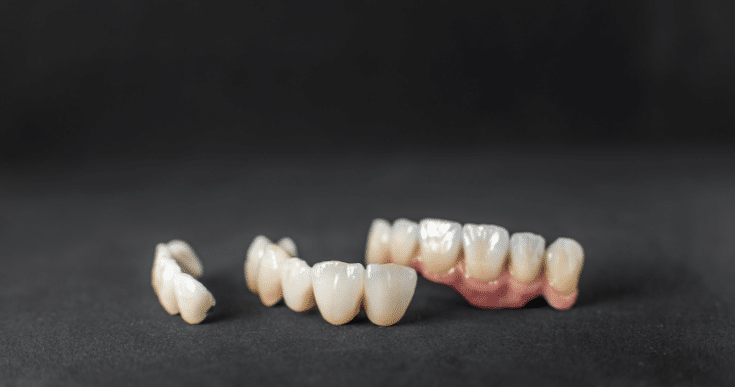 Why Dental Crowns Fall Off and How to Prevent It