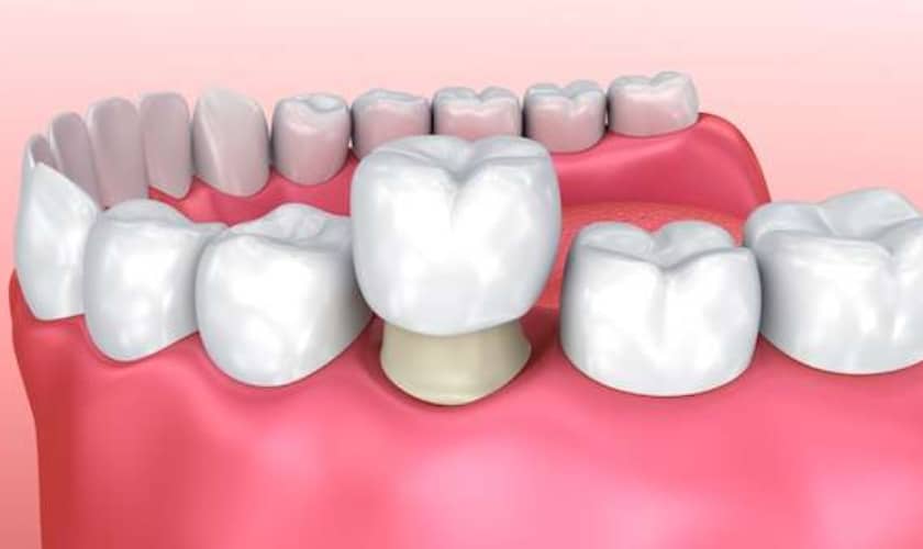 Dental implants can last a lifetime with proper care