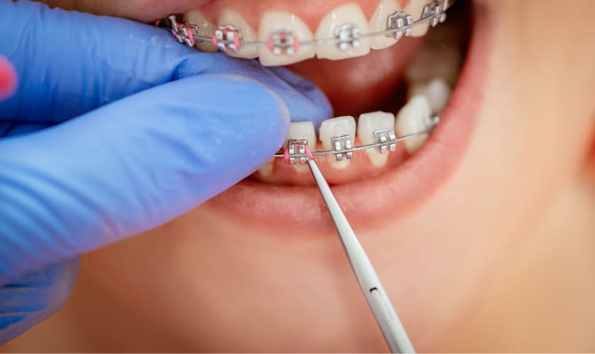 What Age Is Best For Braces?
