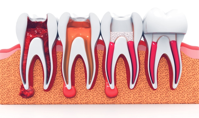 What Are The Symptoms That Cause You To Need A Root Canal?