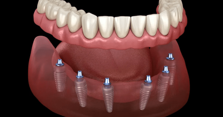How To Prepare For All-On-4 Dental Implant Surgery