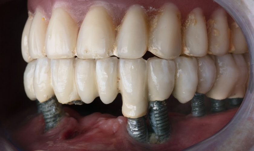 All- on- 4 Dental implants in Pharr- Arcade Dental -Pharr