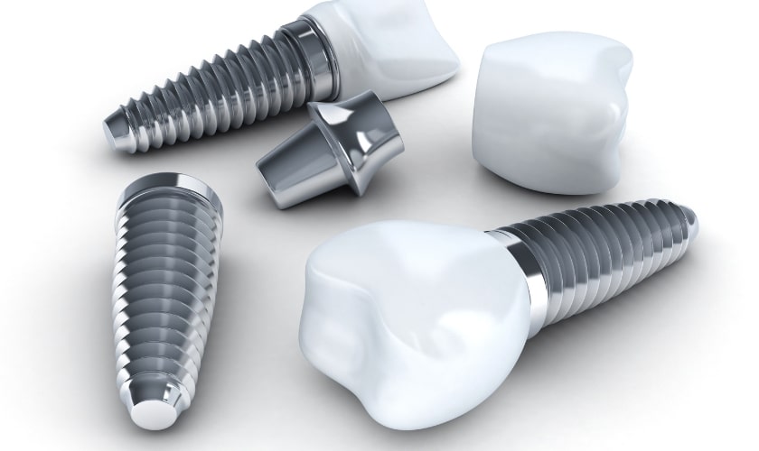 Dental implants can last a lifetime with proper care