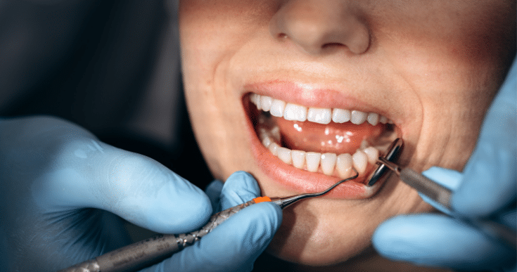 Dental implants can last a lifetime with proper care