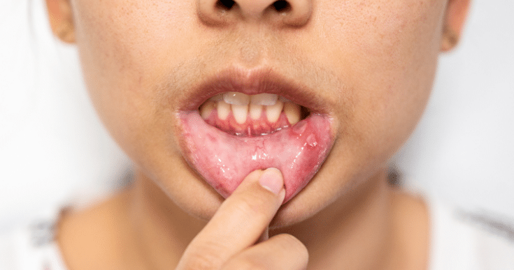 Gum Infection After Root Canal Treatment