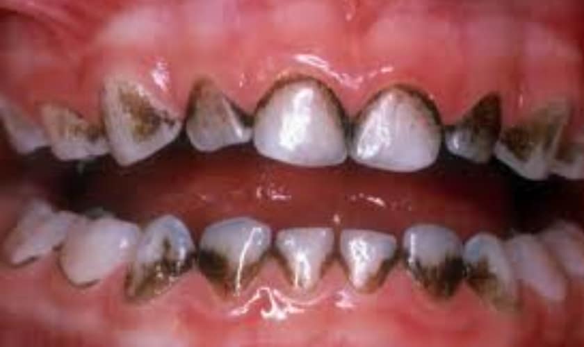 10 Causes Of Black Spots On Teeth