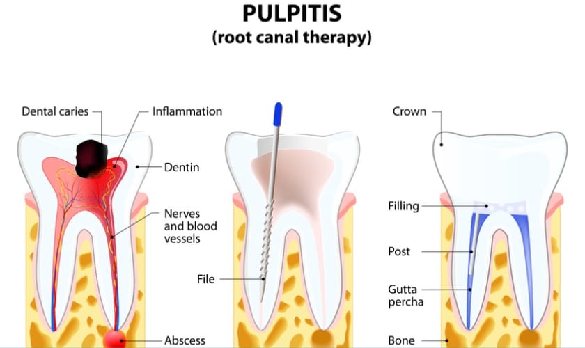 Root Canal Therapy - Arcade Dental - Pharr