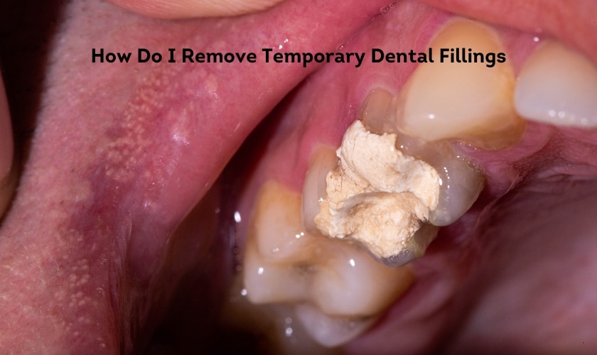 Image showing a dental tool being used to remove a temporary dental filling from a tooth, illustrating the process of temporary filling removal in dental care.