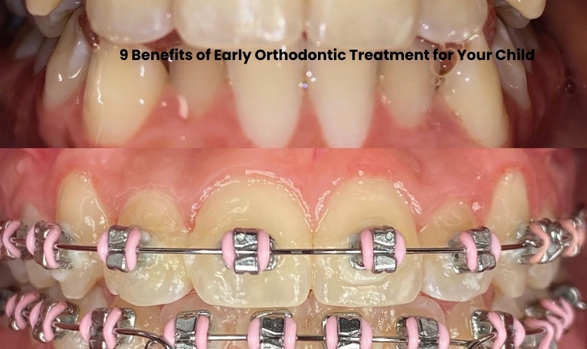 9 Benefits of Early Orthodontic Treatment for Your Child