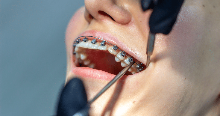 Can Crooked Teeth Be Fixed Without Braces?