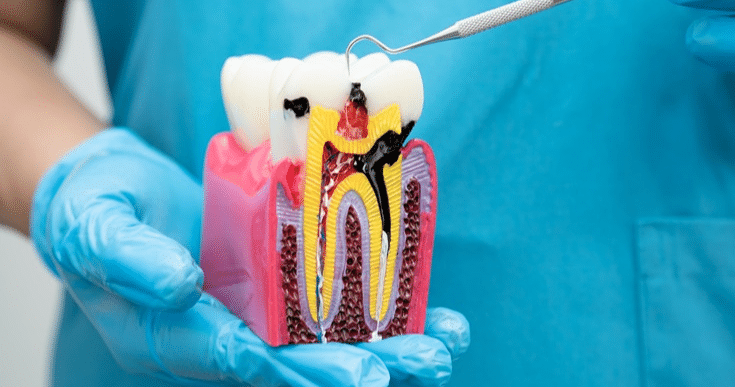 Antibiotics Heal An Infected Root Canal