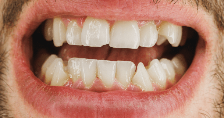 Cracked Tooth Goes Untreated