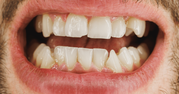 Shouldn’t Ignore a Cracked Tooth