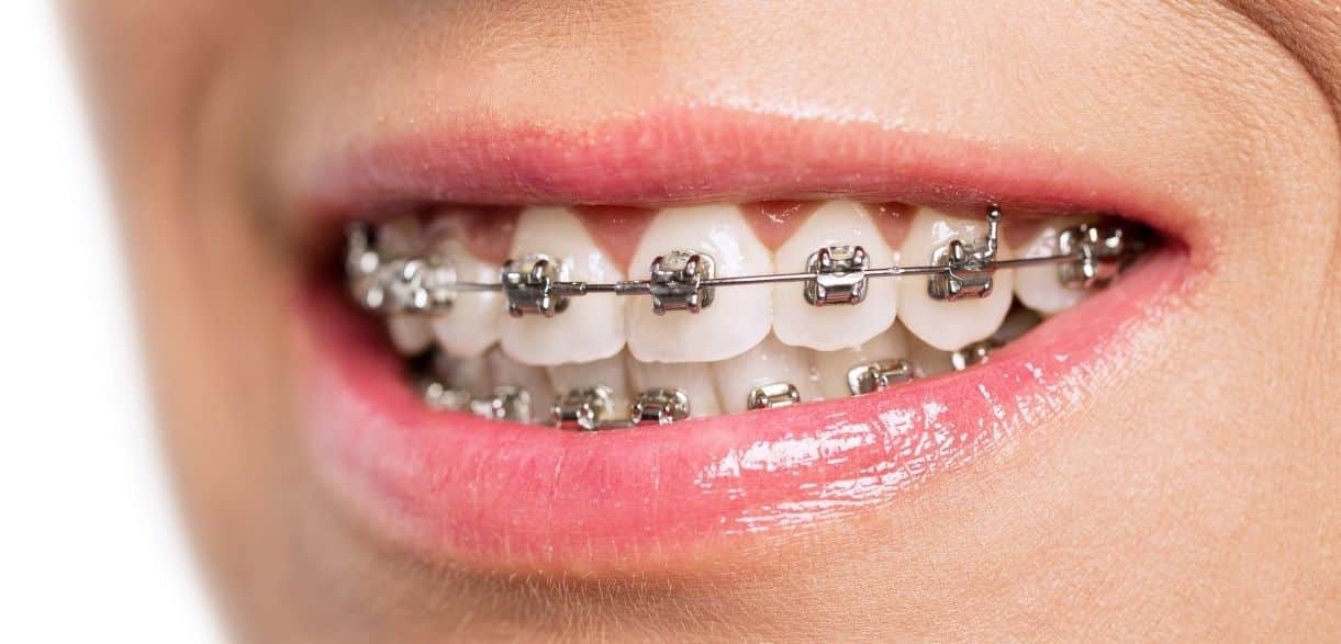 how long does it take to see results with dental braces