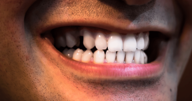 Avoid After Teeth Whitening
